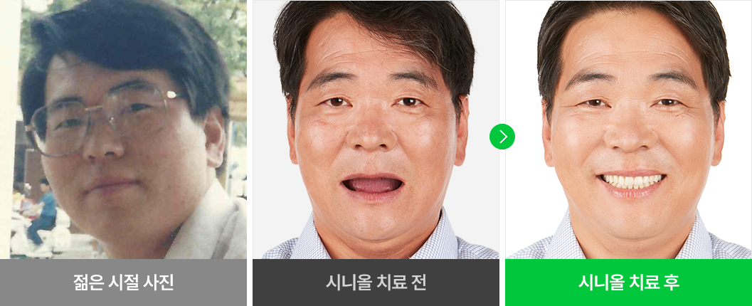 환자분 개개인의 얼굴형에 맞는 임플란트 치료