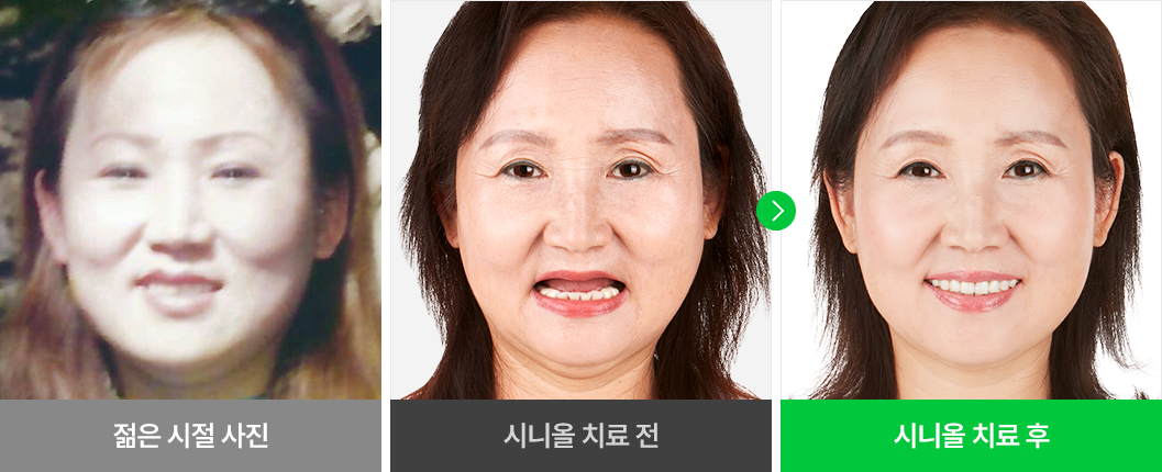 환자분 개개인의 얼굴형에 맞는 임플란트 치료