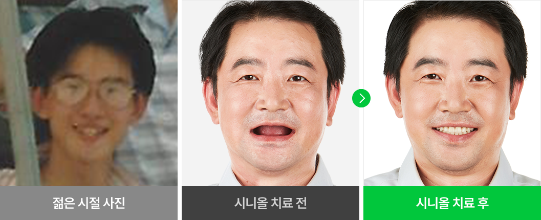 환자분 개개인의 얼굴형에 맞는 임플란트 치료