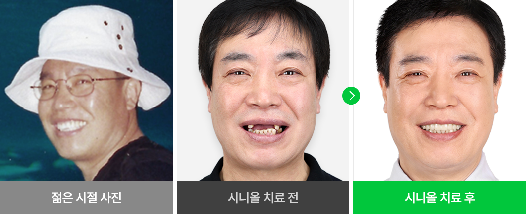 환자분 개개인의 얼굴형에 맞는 임플란트 치료