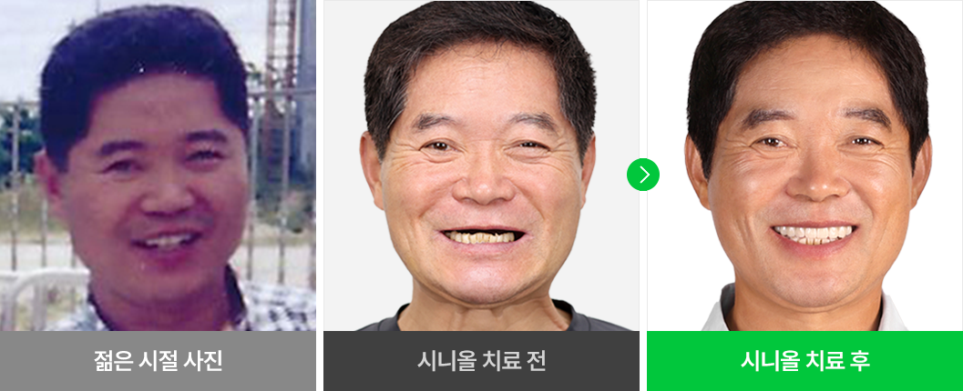 환자분 개개인의 얼굴형에 맞는 임플란트 치료