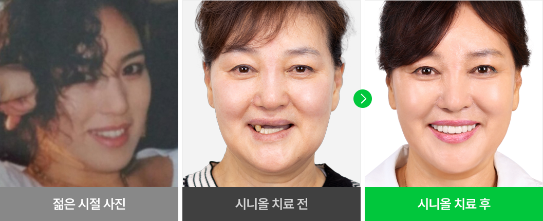 환자분 개개인의 얼굴형에 맞는 임플란트 치료