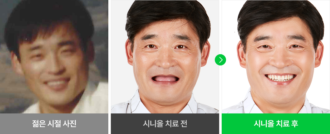 환자분 개개인의 얼굴형에 맞는 임플란트 치료