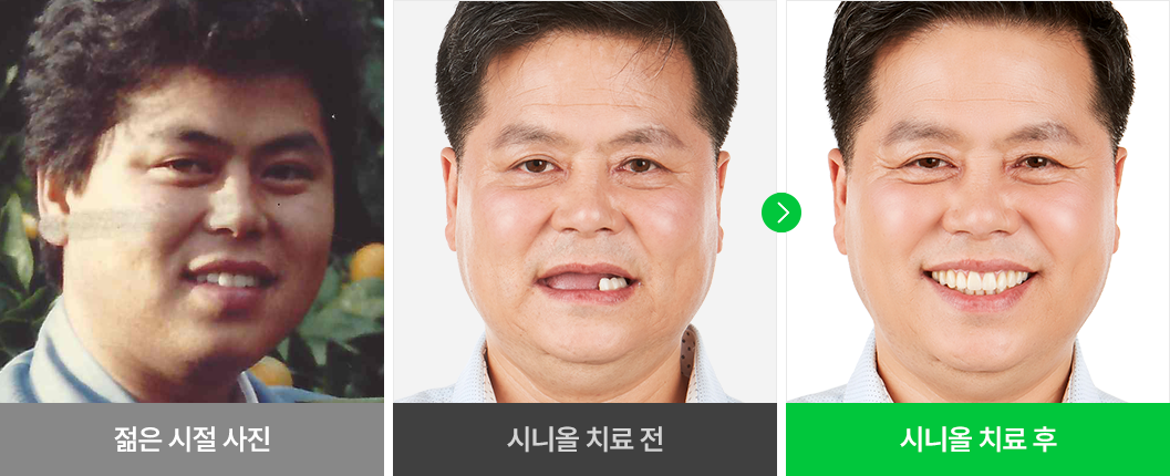 환자분 개개인의 얼굴형에 맞는 임플란트 치료