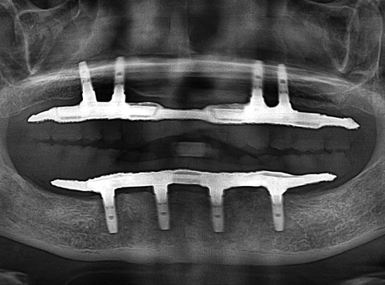 식립 개수를 줄인 시니올 임플란트