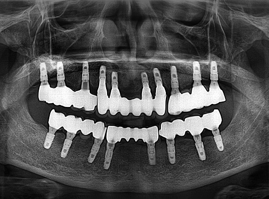 식립 개수가 많은 과거의 임플란트