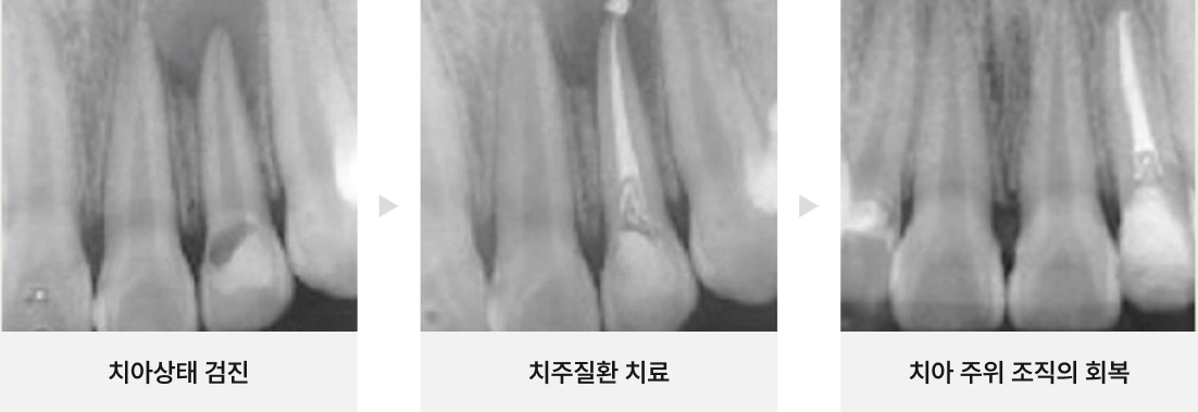 뿌리 끝에 염증이 있는 치아 살리기